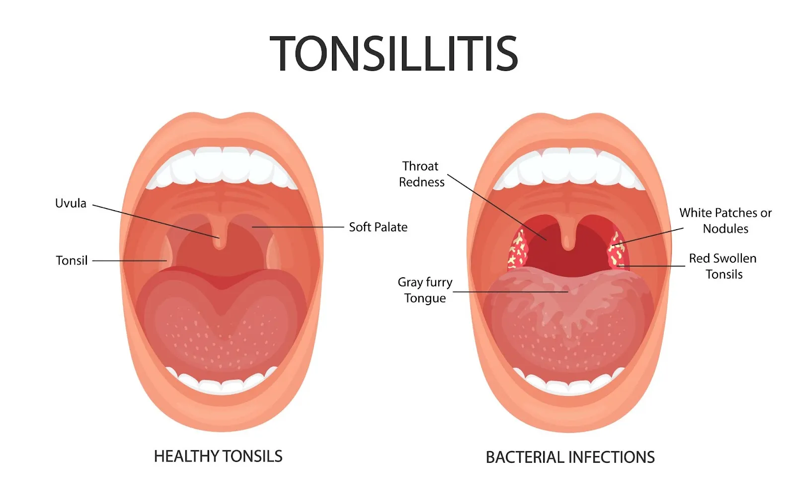 tonsilitis